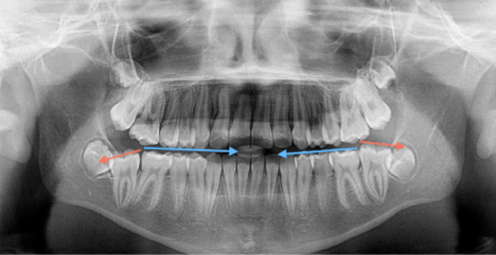 molars