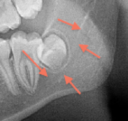 root-canal