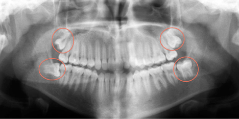 wisdom-teeth