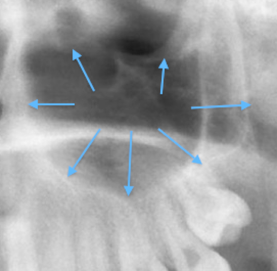 wisdom-tooth-extraction